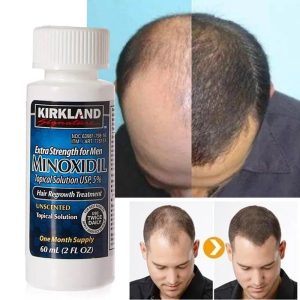 MINOXIDIL BEARD GROWTH