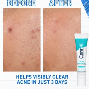 Acne Control Gel