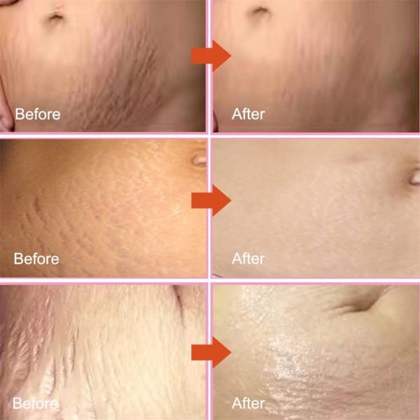 Stretch Marks Fading Cream Maternity Scars Acne Cream Pregnancy Stretch Marks Remove Cream Repair Anti-Aging Winkle Firmng Body Cream (3 PCS) - Image 2